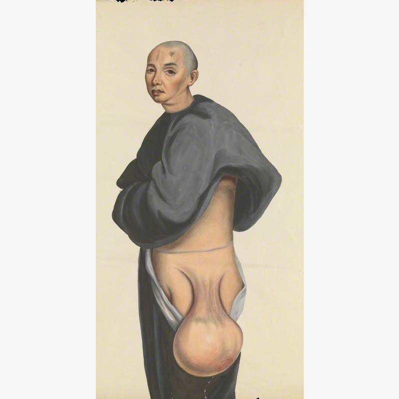 A Man (Kwan Nanking) with a Large Pendent Tumour Hanging from His Hip