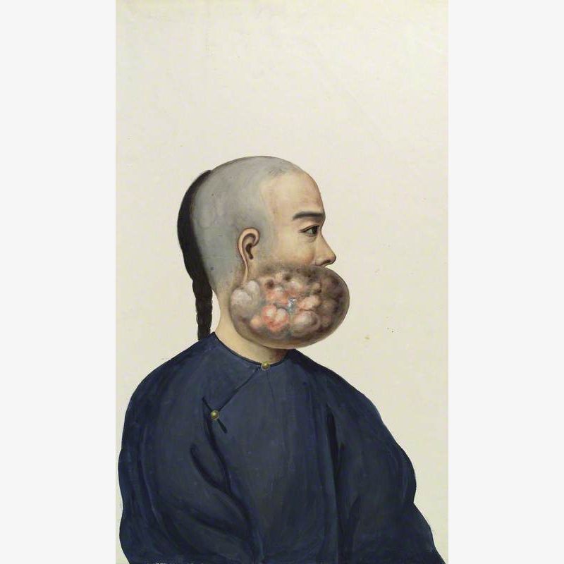 A Man (Leang Ashing), in Profile, with a Tumour on the Right Side of His Face