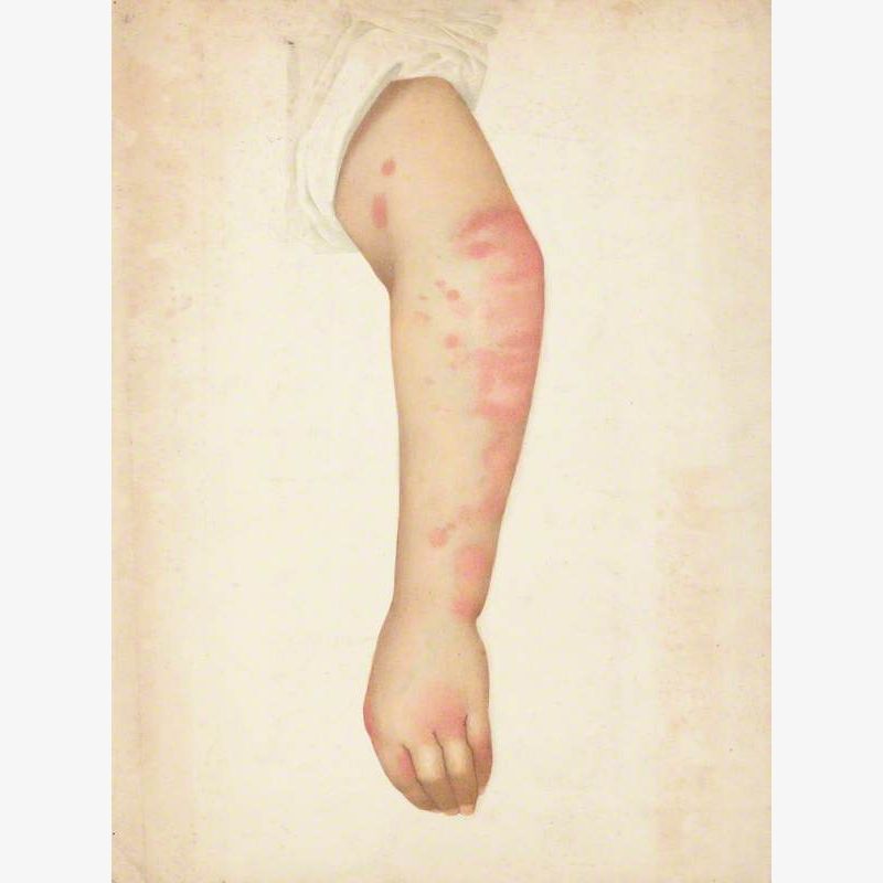 The Arm of a Woman with a Rash